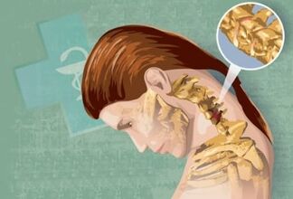 Servikal osteokondrozun refleks semptomları