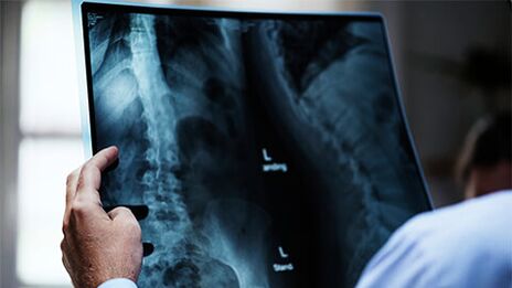 Osteokondrozlu omurganın röntgeni